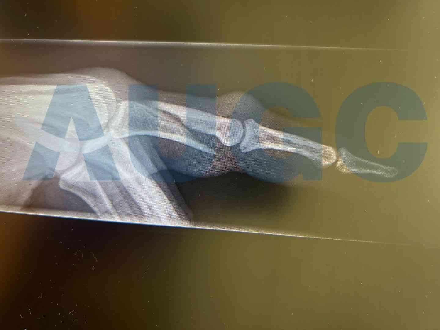 Radiografía dedo fracturado.